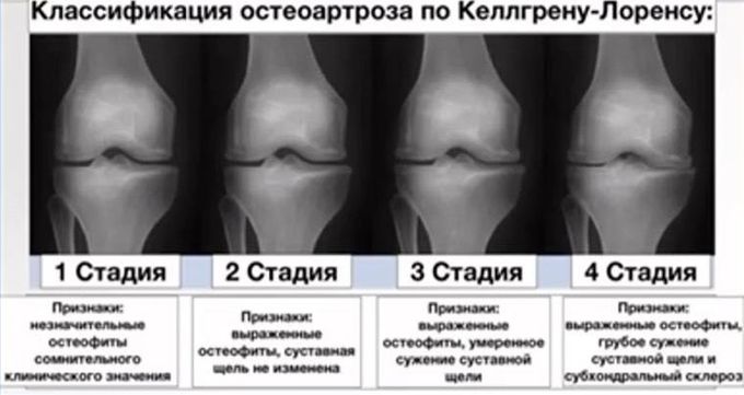 Артрознинг 4 босқичи — рентген тасвирлари