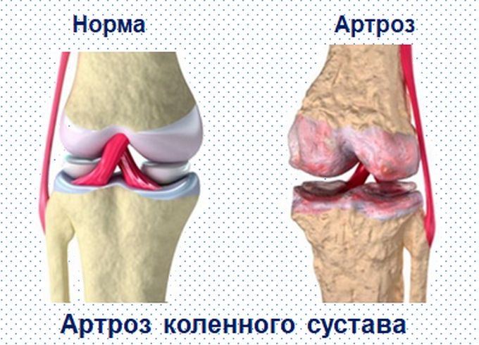 Соғлом бўғим ва артроз билан шикастланган бўғим фарқи